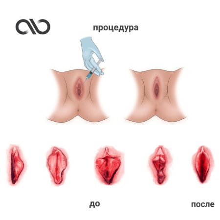 Интимная пластика