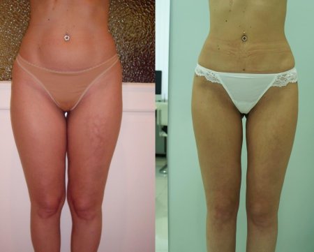 Липосакция липоскульптурирование