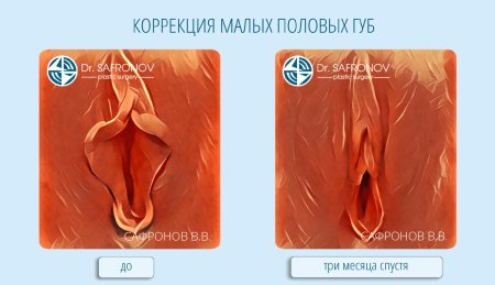 Пластика больших половых губ