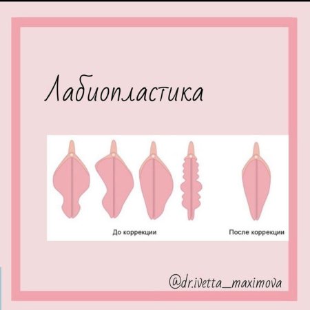 Лабиопластика пластика половых больших губ