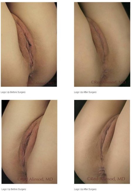 Операция лабиопластика