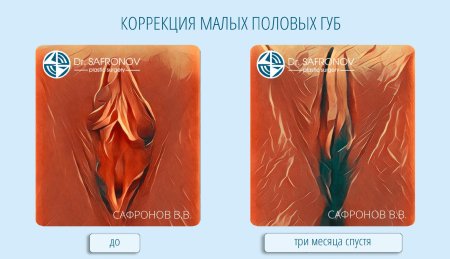 Пластика малых половых губ
