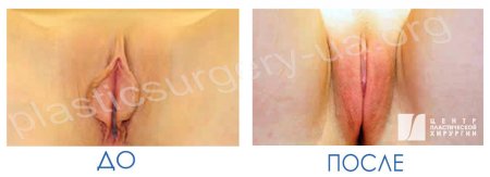 Пластика малых половых губ