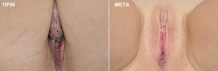 Пластика влагалища