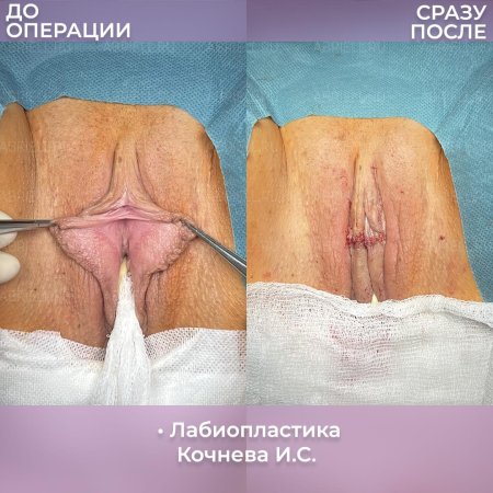 Редукционная лабиопластика