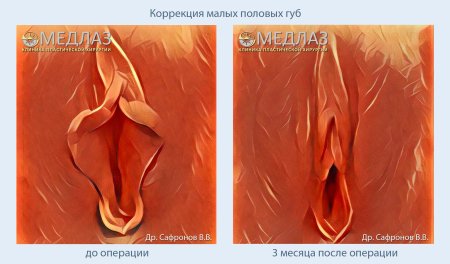 Пластика влагалища