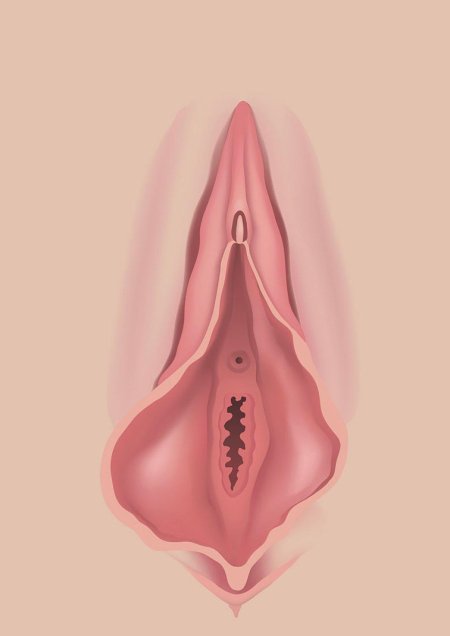 Вагина барби лабиопластика