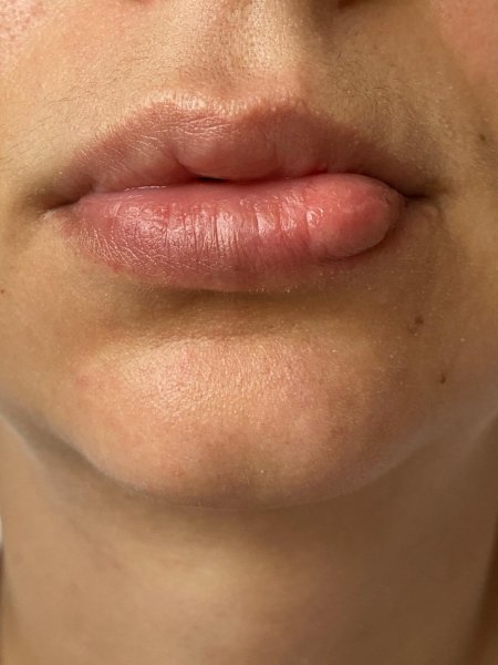 Комки в губах после увеличения
