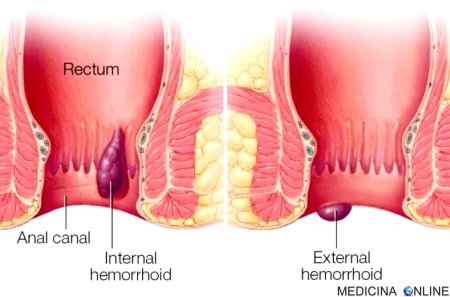 Геморроидальный узел