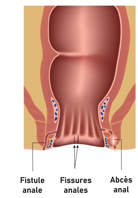 Парапроктит параректальный свищ