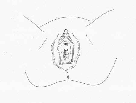 Марсупиализацию бартолиновой железы