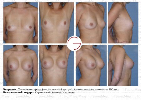 Гинекомастия операция