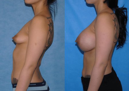 Увеличение груди порно