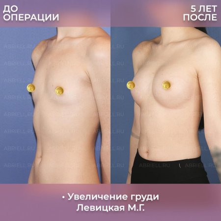 Операция по увеличению груди