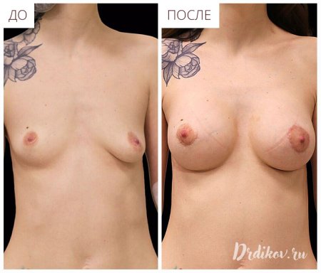 Увеличение груди