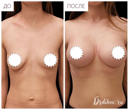 Увеличение грудных желез