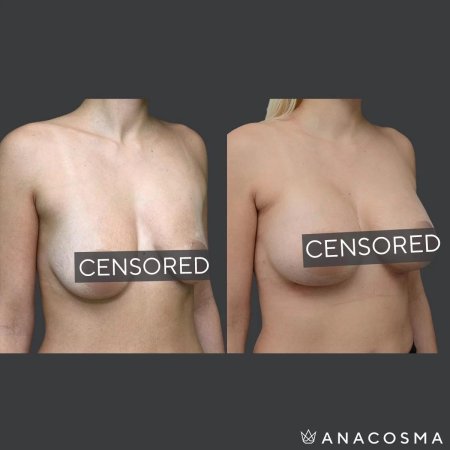 Асимметрия груди у девушек