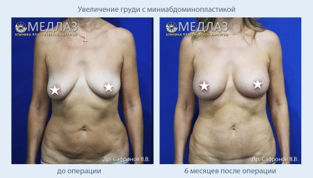 Увеличенная грудь