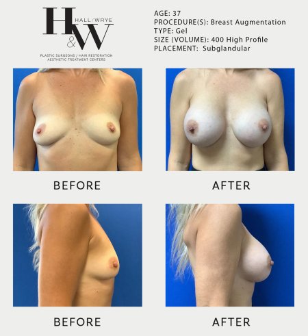 Breast augmentation