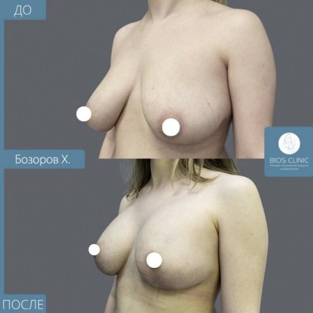 Увеличение груди анатомическими имплантами