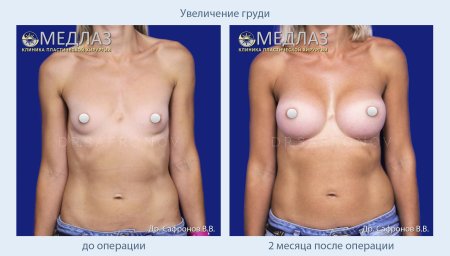 Увеличение груди в москве