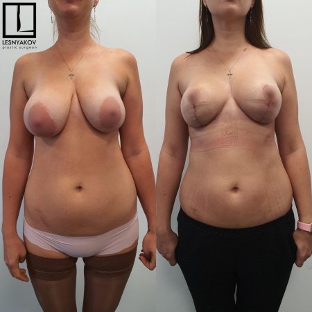 Подтяжка обвисших сисек