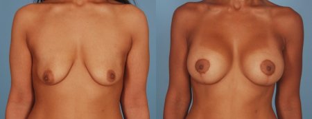 Breast reduction dr. richard
