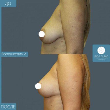 Асимметричная грудь