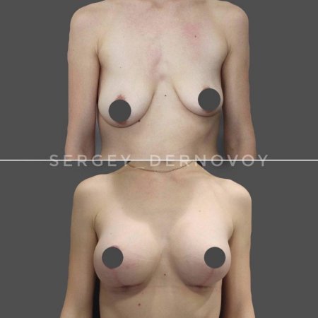 Увеличение груди