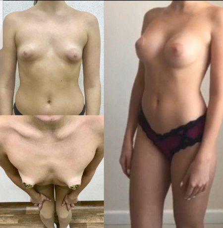 Тубулярная грудь