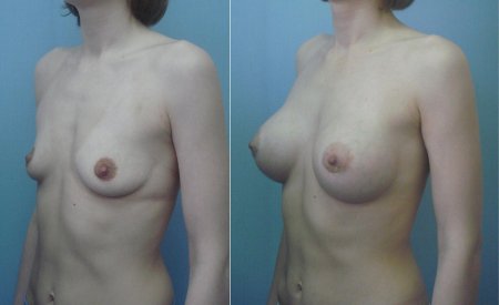 Пластическая хирургия груди