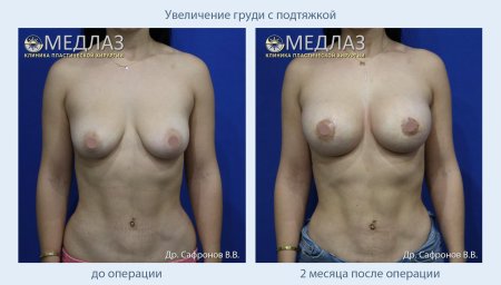 Сиськи до и после увеличения