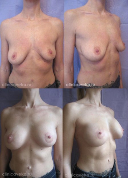 Грудь до и после подтяжки