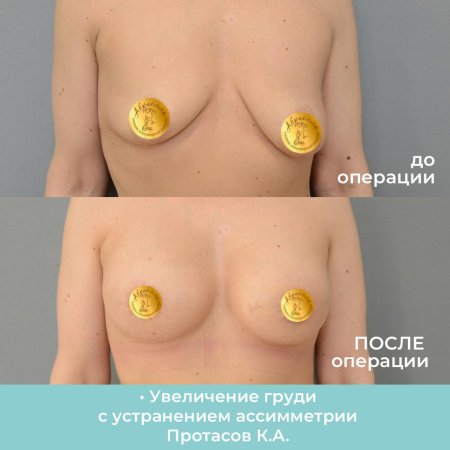 Операция увеличение груди