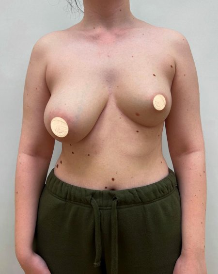 Грудь импланты