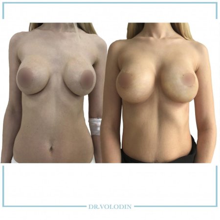 Маммопластика отзывы