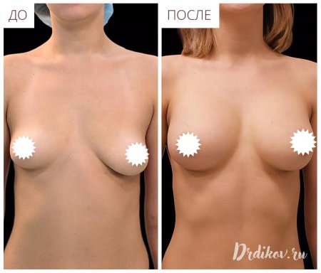 Асимметрия груди у женщин