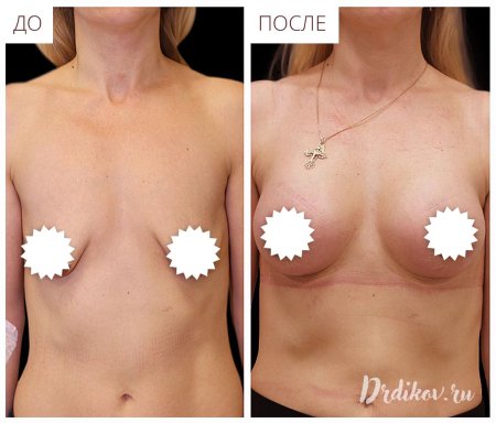 До и после подтяжки груди