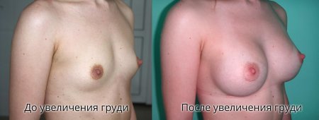 Набухшие молочные железы