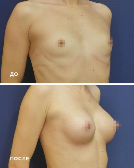 Ассиметричная грудь