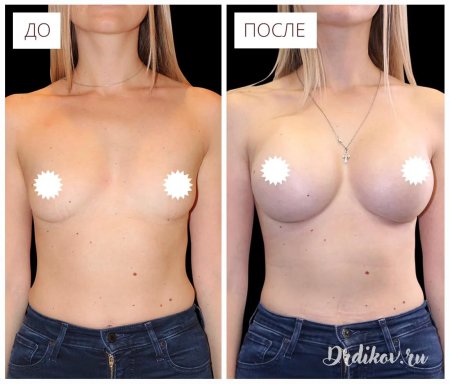 Пластика груди