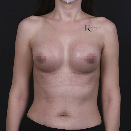 Ассиметричная грудь