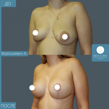 Периареолярная мастопексия