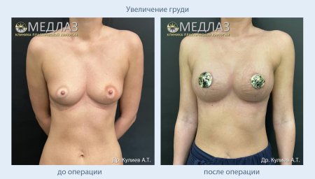 Увеличение груди