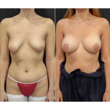 Несимметричная грудь