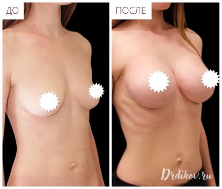 Асимметрия груди