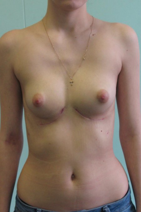 Ассиметричная грудь