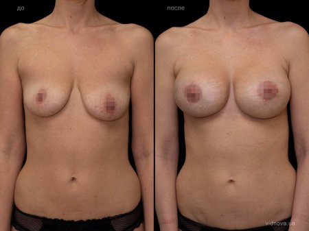 Асимметрия женской груди