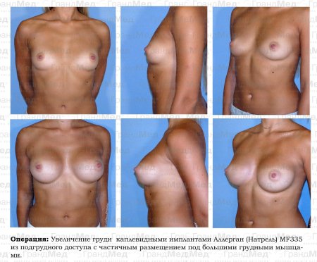 Пластическая операция на грудь