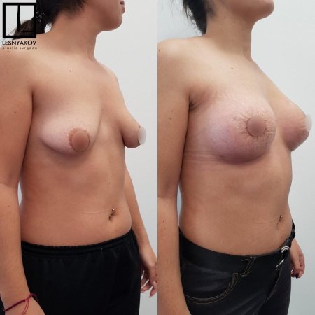 Тубулярная форма молочной железы